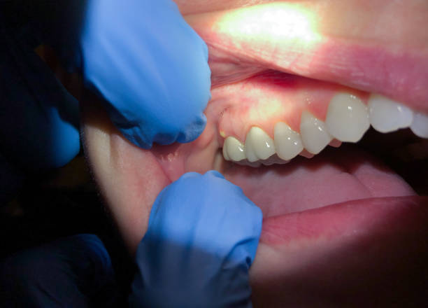 Best Urgent Care for Lost Fillings or Crowns in Venersborg, WA