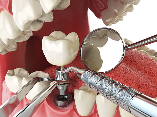 Best Emergency Root Canal Treatment in Venersborg, WA